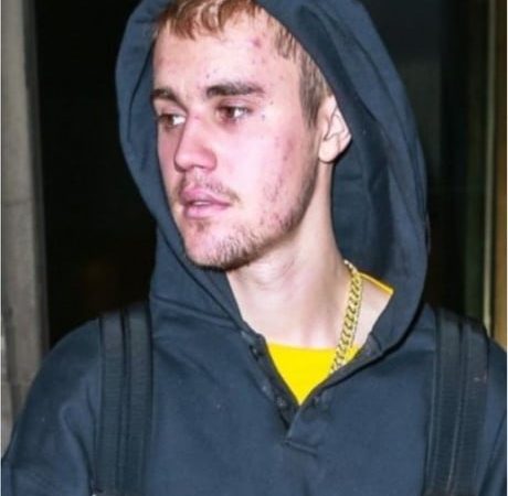 Justin Bieber has Lyme Disease